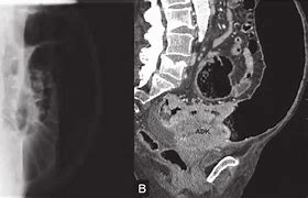 Image result for Carcinoid Tumor in Sigmoid Colon
