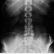 Image result for Lumbar Spine Radiographic Anatomy