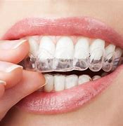 Image result for Clear Teeth Braces