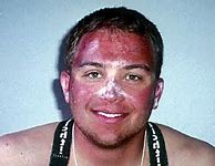 Image result for What to Do for Bad SunBurn