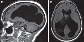 Image result for Hydrocephalus MRI Brain