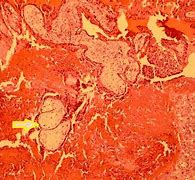 Image result for Stroma Ovary
