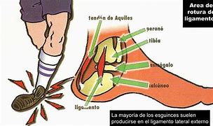 Image result for Causa De Un Esguince