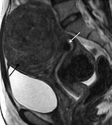 Image result for Fibroid Uterus MRI