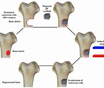 Image result for Jaw Bone Cancer Surgery
