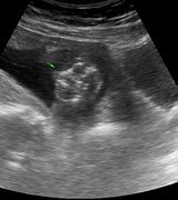 Image result for Anencephaly On Ultrasound