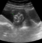 Image result for Anencephaly Ultrasound Front View