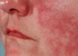 Image result for Lupus Rash around Mouth