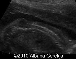 Image result for Spina Bifida Myelomeningocele Encephalocele