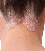 Image result for Scabies in Hair and Scalp