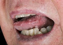 Image result for Small White Warts in the Mouth