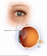 Image result for Lens Dislocation Eye
