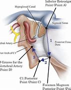 Image result for intervettebral