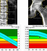 Image result for Bone Mineral Density Osteoporosis