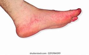Image result for Syphilis Rash On Feet