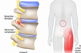 Image result for Lumbar Radiculopathy Nerve Root