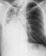 Image result for Carcinoid Crisis