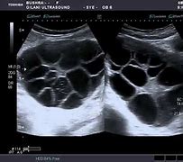 Image result for Theca Lutein Cyst