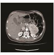 Image result for Pancreas Tail CT AP Pancreatitis