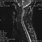 Image result for Cystic Myelomalacia