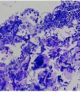 Image result for Candida Esophagitis