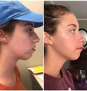 Image result for Jaw Surgery