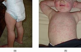 Image result for Fifth Treatment 5th Disease