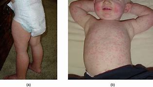 Image result for Fifths Disease Rash On Body