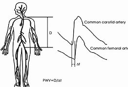 Image result for Carotid or Femoral Pulse