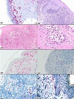 Image result for Mycosis Fungoides Cribriform Pattern Histology