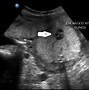 Image result for Fetal Ascites Ultrasound