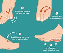 Image result for Tumor On Foot