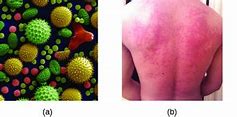 Image result for Food Allergy Skin Rash
