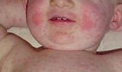 Image result for 5th Disease