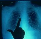 Image result for X-rays of Chest After CPR