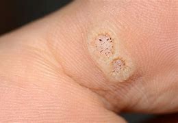 Image result for Plantar Wart