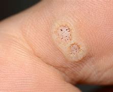 Image result for Plantar Wart Removal Hand