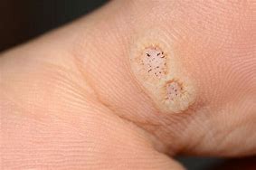 Image result for Plantar Warts On Feet