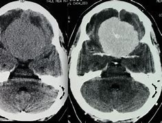 Image result for Left Temporal Meningioma