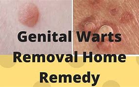 Image result for Genital Wart Removal Disease