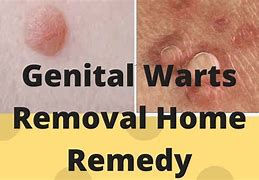 Image result for Genital Warts Home Treatment