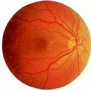 Image result for Retinal Dystrophy