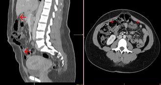 Image result for Rectus Abdominis Diastasis