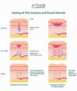 Image result for Surgical Wart Removal