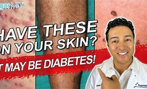 Image result for Diabetic Skin Rash Treatment
