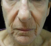 Image result for Wrinkles around Mouth and Lips