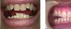 Image result for Braces Before and After
