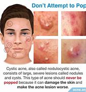 Image result for 1 Cm Nodule