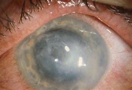 Image result for Contact Lens Halo Eye Infection