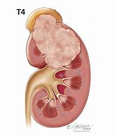 Image result for Large Renal Mass On Kidney